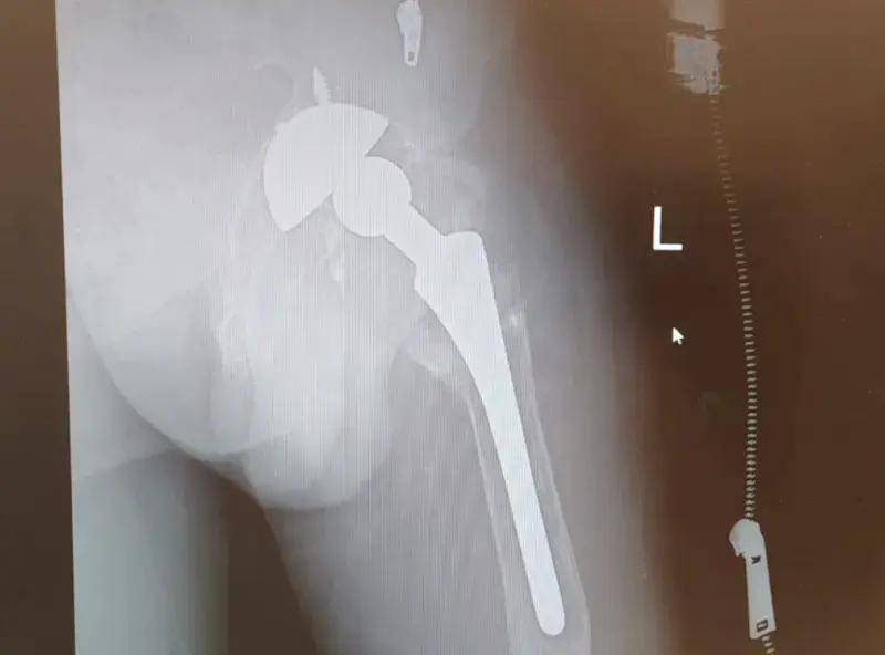 拔牙进了ICU！福州男子险没命！医生紧急提醒