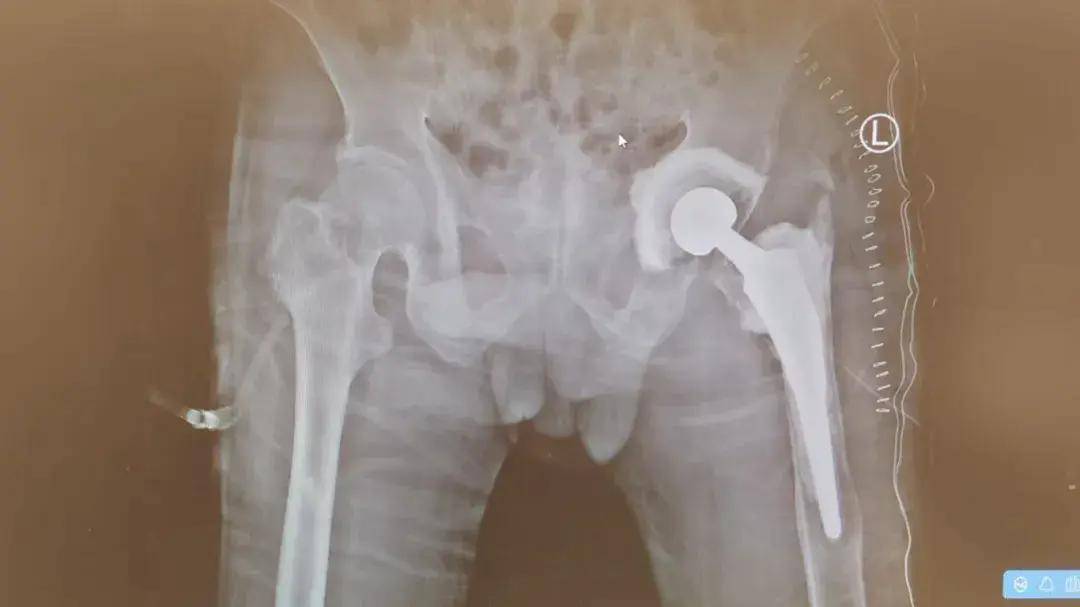 拔牙进了ICU！福州男子险没命！医生紧急提醒